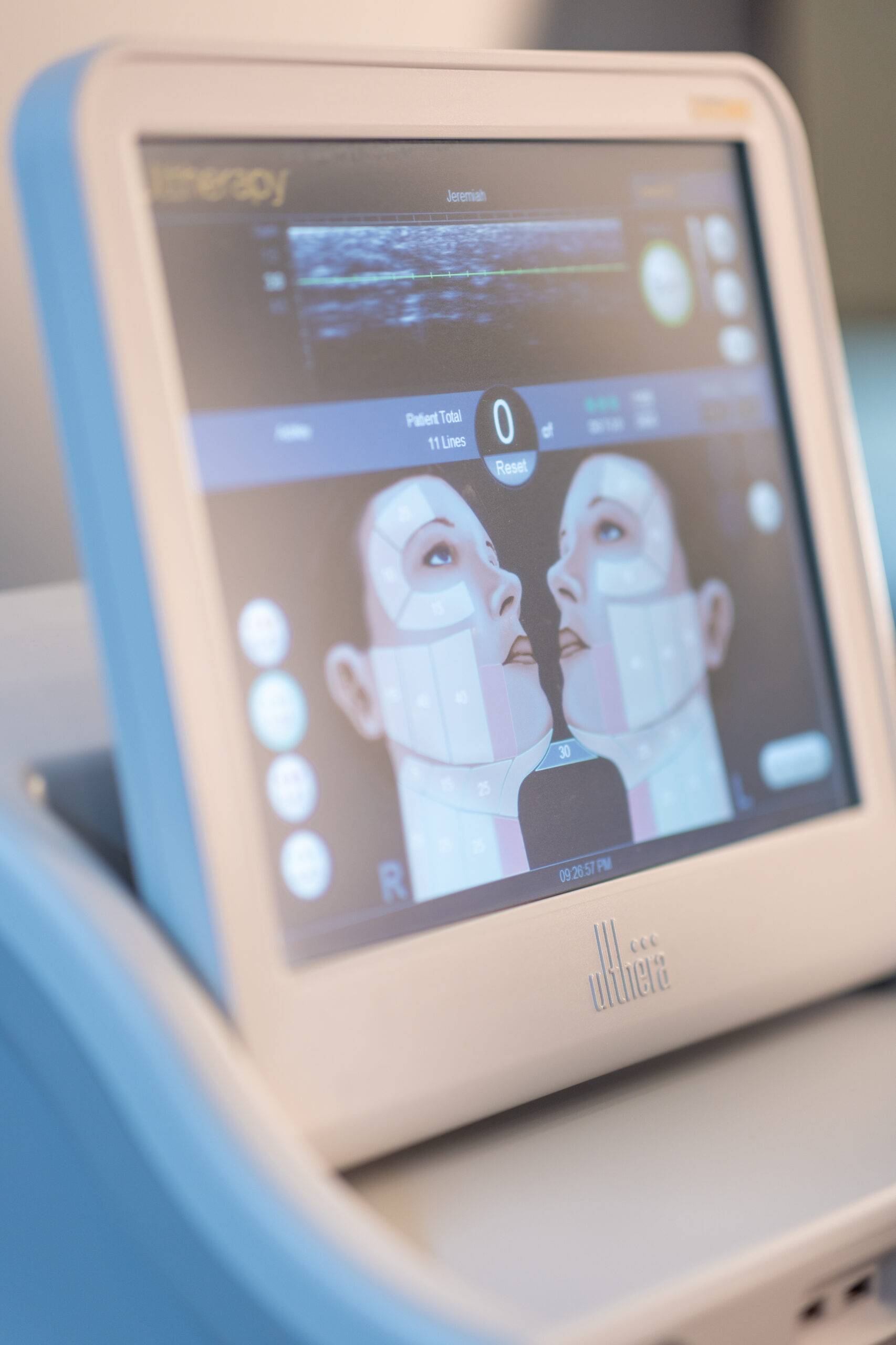 Close-up of a medical device screen displaying a graphic interface for Ultherapy skin tightening treatment, with illustrated faces and adjustment settings.