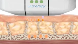 Illustration of an Ultherapy device applying ultrasound energy to skin tissue. The device targets beneath the surface, affecting subcutaneous layers for effective skin lifting. The image captures the process of non-invasive skin tightening.