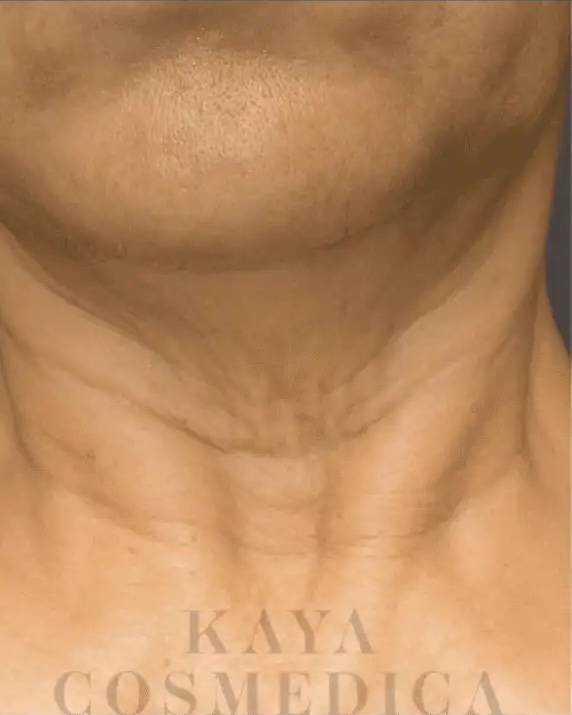 Screen-Shot-2023-12-22-at-52724-pm - Kaya Cosmedica Close-up of the lower face and neck showing skin texture and visible horizontal neck lines, highlighting the need for neck rejuvenation. The image has "Kaya Cosmedica" faintly visible at the bottom.