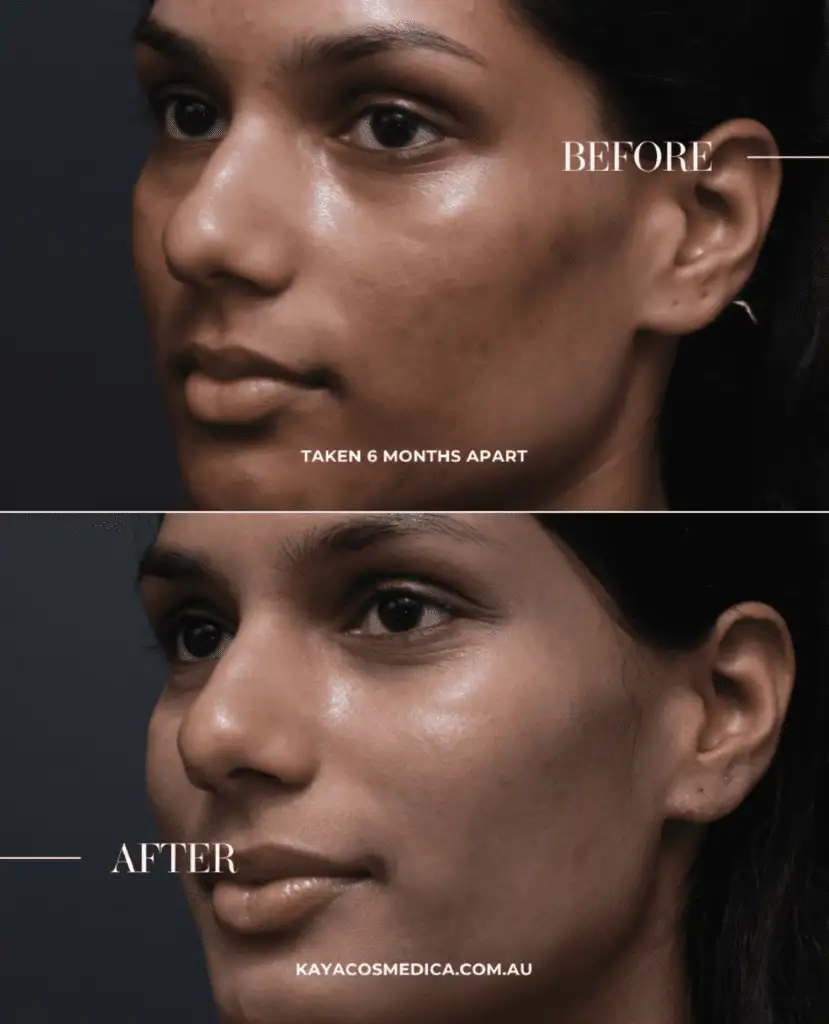 Screenshot 2025-02-03 at 161920 - Kaya Cosmedica Side-by-side images of the same person's face. The top image, labeled "before," shows darker marks, while the bottom image, taken six months later after a pigmentation treatment, displays clearer skin. Text at the bottom reads "kayacosmedica.com.au".