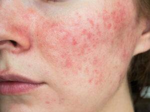 Close-up of a person's face showing redness and acne-like inflammation associated with rosacea on the cheek, including small red bumps. The skin texture appears uneven, highlighting the importance of careful skin care around the mouth and chin.